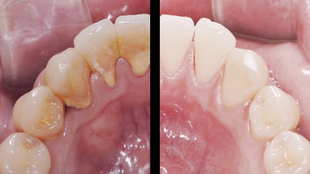 Dental Scaling